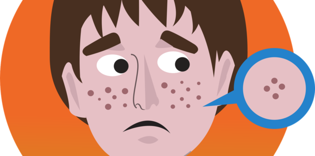 découvrez les causes, symptômes et traitements efficaces de l'acné hormonale chez l'adulte pour une peau claire et équilibrée.